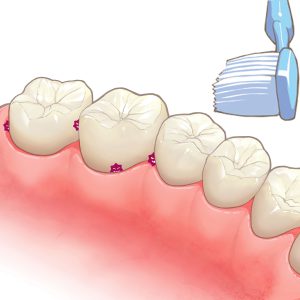 歯の磨き残し
