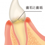 歯肉炎