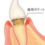 軽度歯周病