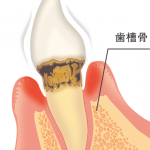 中度歯周病