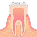 虫歯初期