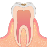 虫歯中期