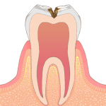 虫歯の後期状態