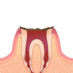 虫歯末期