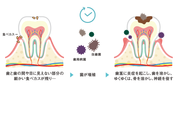 虫歯と歯周病の原因