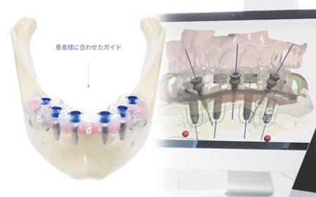 サージカルガイドを使用したDIOインプラント