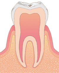 虫歯C0