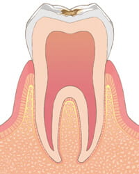 虫歯C1