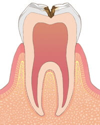 虫歯C1