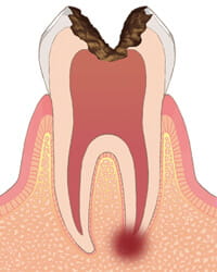 虫歯C1