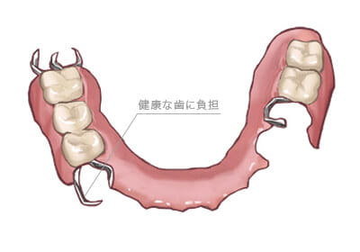 入れ歯
