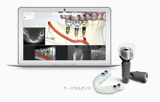 東大阪市で安心してインプラントをするならサージカルガイドを使用したDIOインプラントがおすすめ