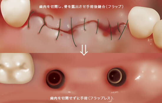 東大阪市でノンフラップインプラントをするなら多賀歯科医院