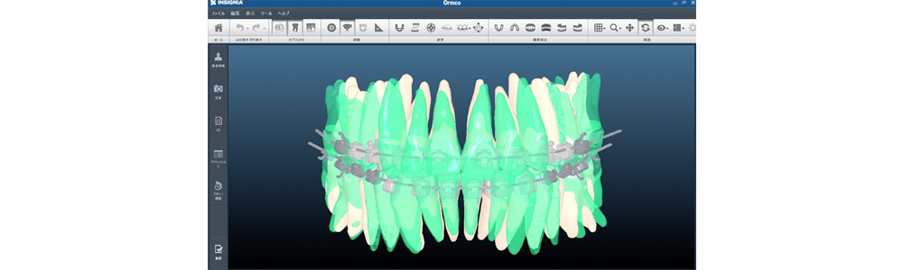 インシグニア矯正の治療計画