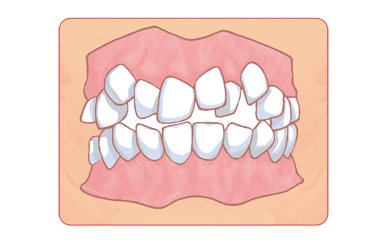 矯正治療の難症例