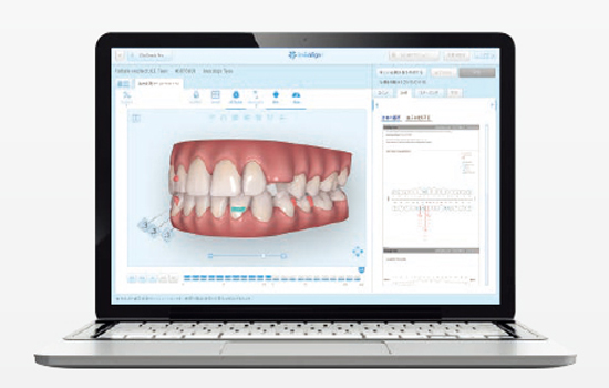 インビザライン矯正