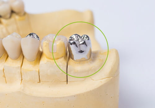 銀歯（金銀パラジウム合金）のかぶせ物