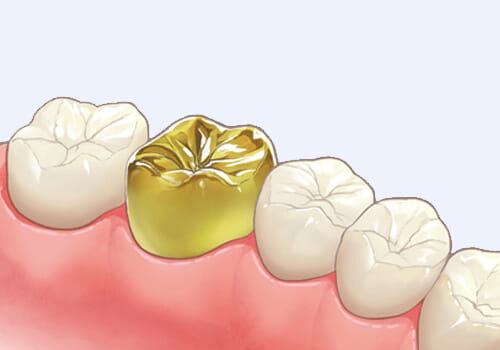 ゴールドのかぶせ物