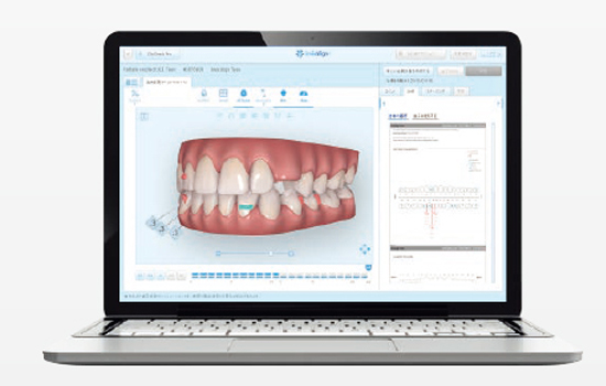 インビザライン矯正